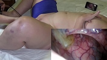 Inside Analsluts arse - Air belly inflation and anal endoscope